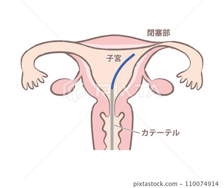 輸卵管鏡輸卵管成形術子宮圖 110074914