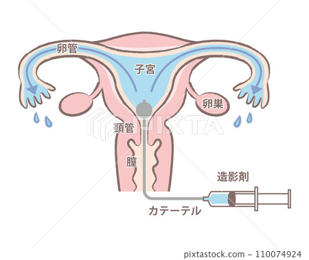 Salpingography examination - Illustration of the uterus with good passage of the fallopian tubes - Explanation diagram - text included 110074924
