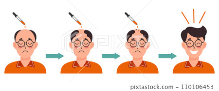 Human hair transplantation and treatment of baldness. Man before and after hair treatment. Healthcare and medicine. Cartoon illustration, vector 110106453