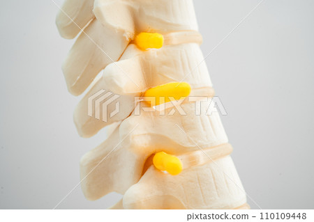 Lumbar spine displaced herniated disc fragment, spinal nerve and bone. Model for treatment medical in the orthopedic department. 110109448