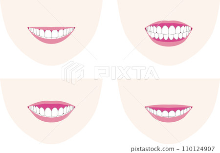 Gummy smiles, where the gums show when you smile. Vector illustration of how the smile and teeth look 110124907