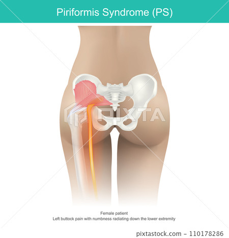 Piriformis syndrome. a condition in which nerve compression in the muscles, located in the buttock region causes buttocks pain and down to thigh in women. 110178286