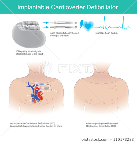 Implantable Cardioverter Defibrillator. 110178288