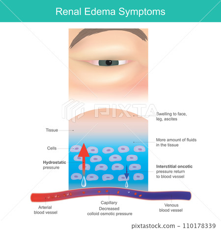 Renal Edema Symptoms. Severe swelling the medical called edema, occur particularly around eyes. 110178339