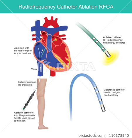 Radio frequency Catheter Ablation. Medical procedure is used to help control the heart rhythm problems such as atrial fibrillation. 110178340