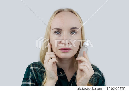 Vitamin A, Retinol, Niacinamide, Vitamin C. Girl smears her face with antioxidant anti-wrinkle cream. Anti-aging and facial rejuvenation agent. Before and after. Visual result. Acne treatment 110200761