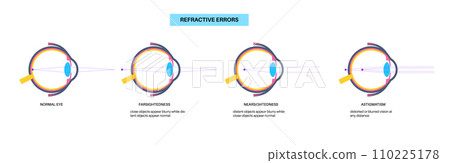 Refractive errors poster 110225178