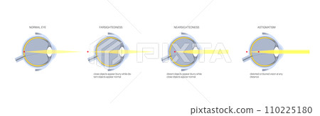Refractive errors poster 110225180