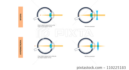Astigmatism eye disease Astigmatism eye disease 110225183