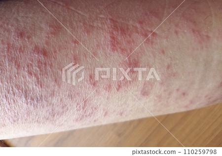 rash eczema dermatitis  on leg. inflammation of skin 110259798