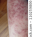 rash eczema dermatitis  on leg. inflammation of skin 110259800