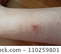 rash eczema dermatitis  on leg. inflammation of skin 110259801