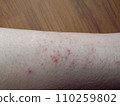 rash eczema dermatitis  on leg. inflammation of skin 110259802