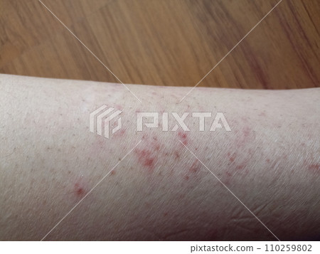 rash eczema dermatitis on leg. inflammation of skin rash eczema dermatitis on leg. inflammation of skin 110259802