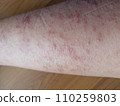rash eczema dermatitis  on leg. inflammation of skin 110259803