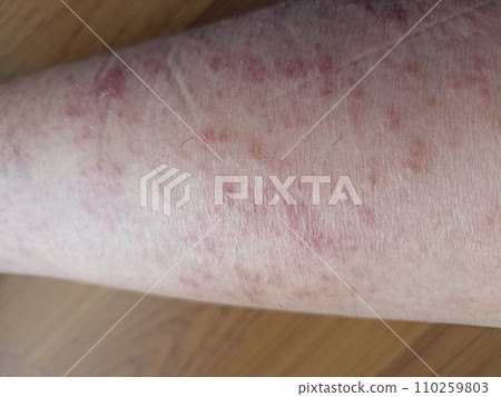 rash eczema dermatitis on leg. inflammation of skin rash eczema dermatitis on leg. inflammation of skin 110259803