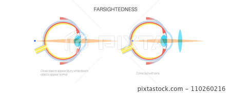 Normal eye and farsightedness Normal eye and farsightedness 110260216
