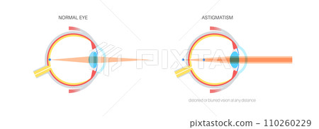 Astigmatism eye disease Astigmatism eye disease 110260229