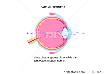 Farsightedness eye disease Farsightedness eye disease 110260230