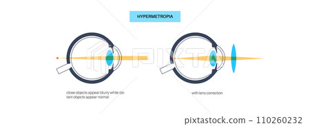 Normal eye and farsightedness Normal eye and farsightedness 110260232