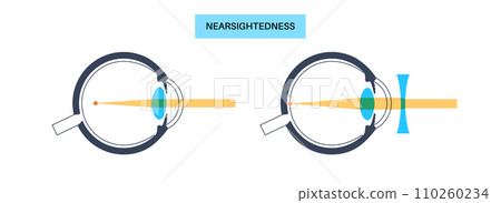 Normal eye and nearsightedness Normal eye and nearsightedness 110260234