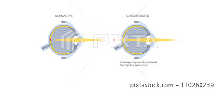 Normal eye and farsightedness Normal eye and farsightedness 110260239