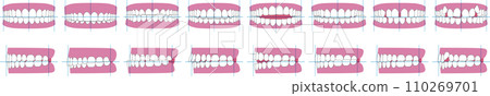 Types of tooth alignment and malocclusion. Front and side vector illustration 110269701