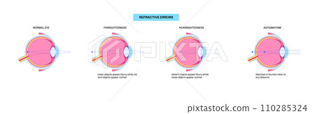 Refractive errors poster 110285324