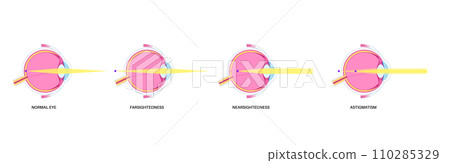 Refractive errors poster 110285329