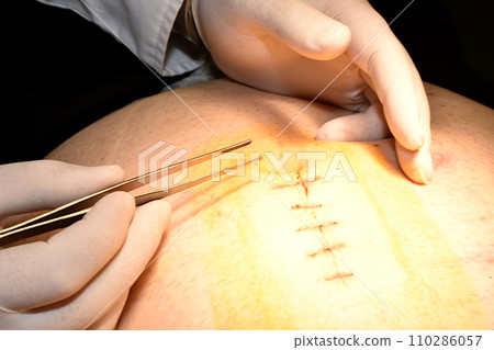 Operation, removal of threads from a seam on a person s stomach. 110286057