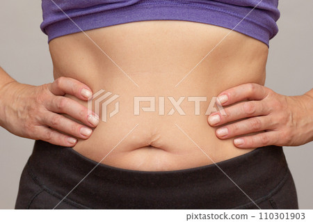 Cropped woman body with hands on waist showing belly sagging skin after diet and stretch marks Cropped woman body with hands on waist showing belly sagging skin after diet and stretch marks 110301903