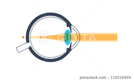 Astigmatism eye disease 110316949