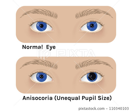 Realistic human normal eyes and with anisocoria 110340103