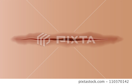 Healing wounds, skin scar, stitched gash and cut. Realistic surgical suture, stitched wounds. Healing stage on human skin background. Vector illustration Healing wounds, skin scar, stitched gash and cut. Realistic surgical suture, stitched wounds. Healing stage on human skin background. Vector illustration 110370142