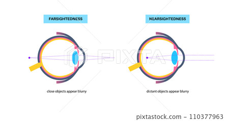 Farsightedness and nearsightedness 110377963