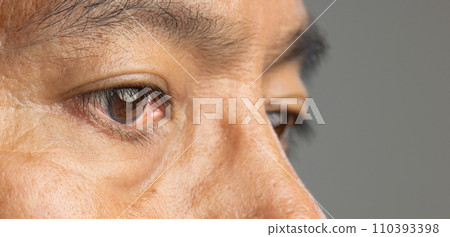 Senior man has cataracts. Generally, cataracts are common in older people. 110393398