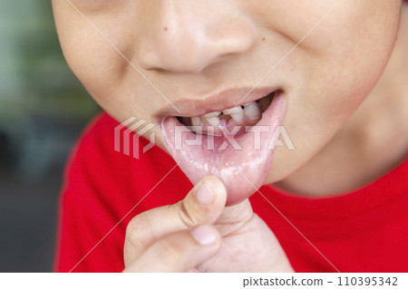 Child milk teeth fall out from gum. little boy permanent tooth grows in mouth. Cute kid open her mouth show teeth and gums. Concept of health, dentist, hygiene, medical, Healthy teeth, dental clinic. Child milk teeth fall out from gum. little boy permanent tooth grows in mouth. Cute kid open her mouth show teeth and gums. Concept of health, dentist, hygiene, medical, Healthy teeth, dental clinic. 110395342