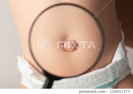An umbilical hernia in a child on the stomach through a magnifying glass. Treatment of dilated umbilical ring, medical. Close-up An umbilical hernia in a child on the stomach through a magnifying glass. Treatment of dilated umbilical ring, medical. Close-up 110431377