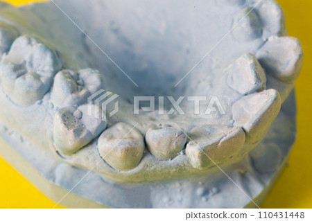 Blue plaster model of an impression of a patient s jaw at an orthodontist s dentist, close-up. Crooked teeth, correction of malocclusion, macro Blue plaster model of an impression of a patient s jaw at an orthodontist s dentist, close-up. Crooked teeth, correction of malocclusion, macro 110431448