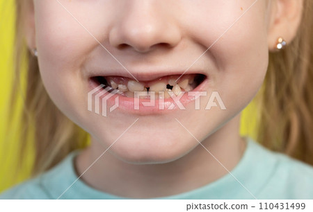 Smiling mouth of a girl with uneven growing molars and baby teeth. Pediatric dentistry, close-up. Malocclusion in children. Aesthetic dental restoration Smiling mouth of a girl with uneven growing molars and baby teeth. Pediatric dentistry, close-up. Malocclusion in children. Aesthetic dental restoration 110431499
