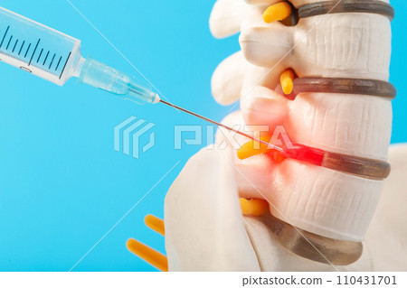 Medical blockade in the intervertebral disc herniation of the lumbar spine on a blue background. Concept for the treatment of protrusions and hernias of the spine. Copy space for text, vertebrology Medical blockade in the intervertebral disc herniation of the lumbar spine on a blue background. Concept for the treatment of protrusions and hernias of the spine. Copy space for text, vertebrology 110431701