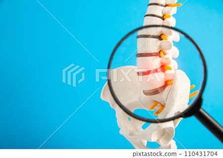 Model of the lumbar spine with a red intervertebral hernia and protrusion on a blue background under a magnifying glass. Concept of osteochodrosis and spondyloarthrosis and spinal arthritis. Copy 110431704