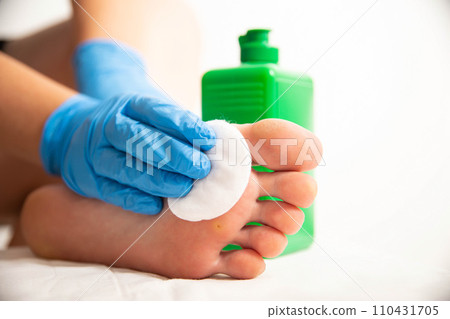 The doctor uses a special liquid to burn a removed callus on the foot. Surgical removal of calluses and warts, close-up 110431705