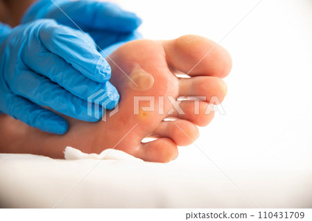 A doctor examines the foot of a person who has a large callus and a stem wart. Treatment and removal of warts and corns, close-up A doctor examines the foot of a person who has a large callus and a stem wart. Treatment and removal of warts and corns, close-up 110431709