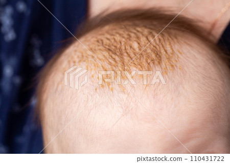 Milk crusts on the head of a newborn child, gneiss. The formation of yellow-golden scales on the head of an infant, close-up 110431722