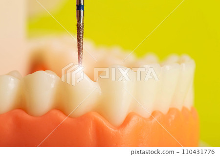 Drilling a diseased tooth with caries with a drill in dentistry during dental treatment, macro. Caries and pulpitis. Copy space for text, modern technology 110431776