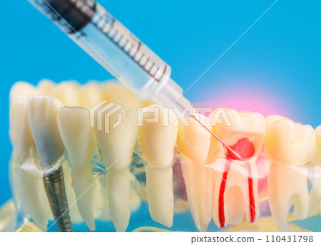 A syringe with an anesthetic anesthetic drug makes an injection into an inflamed tooth of a mock-up of a medical dental jaw on a blue background. Concept of dental treatment under anesthesia and 110431798