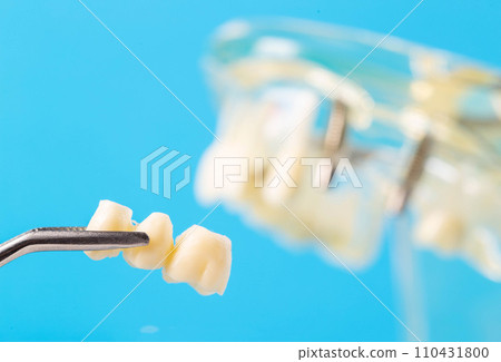 Dental bridge in tweezers against the background of a medical model of the dental jaw, close-up. Dental prosthetics in orthodontics and dentistry. Modern technology. Copy space for text 110431800
