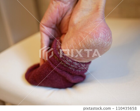 腳跟粗裂 110435658