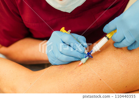 Removal of varicose veins on the legs. Doctor doing sclerotherapy Removal of varicose veins on the legs. Doctor doing sclerotherapy 110440355